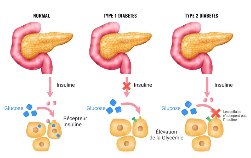 Article Comprendre l'Insuline : Un Pilier de la Santé Métabolique